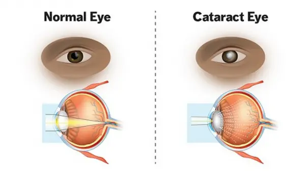 cataractImage